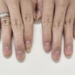 深爪矯正　何本かの爪だけが深爪だけど治るの？