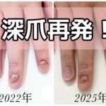 深爪矯正　3年経ってまた再発してしまった！