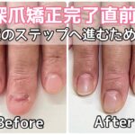 深爪矯正完了直前！次のステップへ進むために