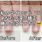 私のダイエット VS あなたの深爪矯正、勝つのはどっち？😎